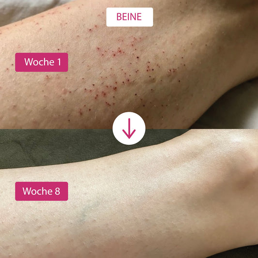 [VIP only] Belle Body IPL ULTRA+